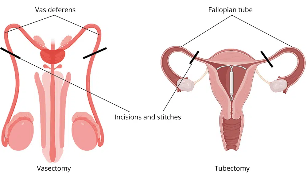 tubal ligation vs vasectomy, permanent contraception, sterilisation methods